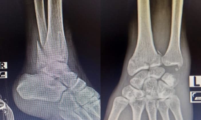 X-ray of right ankle and left wrist